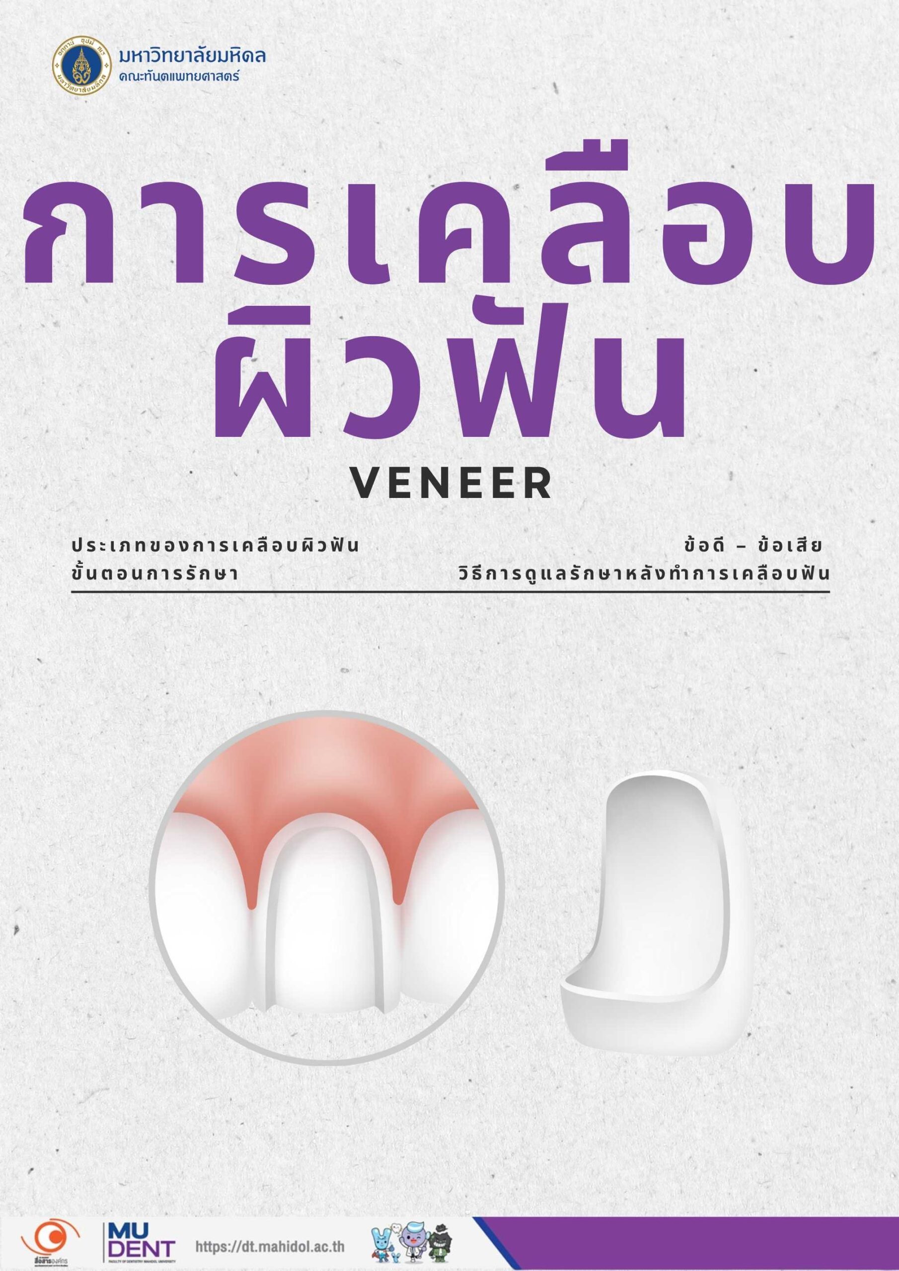 การเคลือบผิวฟัน ( Veneer )