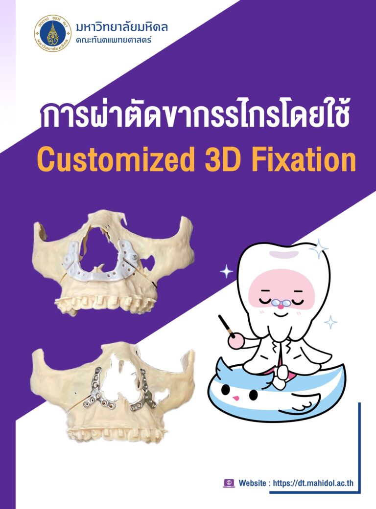 การผ่าตัดขากรรไกรโดยใช้ Customized 3D Fixation