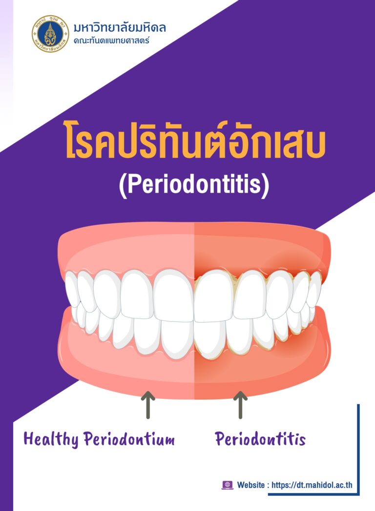 โรคปริทันต์อักเสบ (Periodontitis)